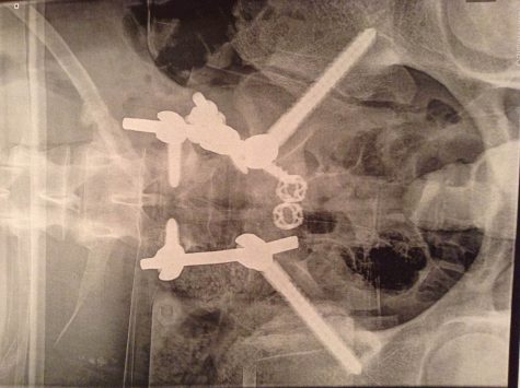 My Spondylolisthesis Story: Braden Cousineau